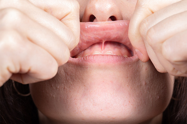 Battle Born Periodontics | Sedation Dentistry, Extractions and Types of Periodontal Disease