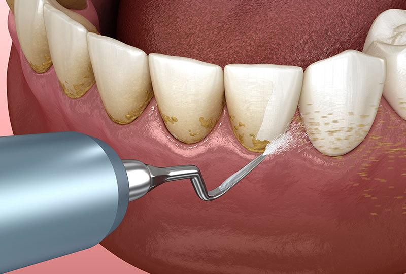 Battle Born Periodontics | Extractions, Treatment of Periodontal Disease and Bone Grafting